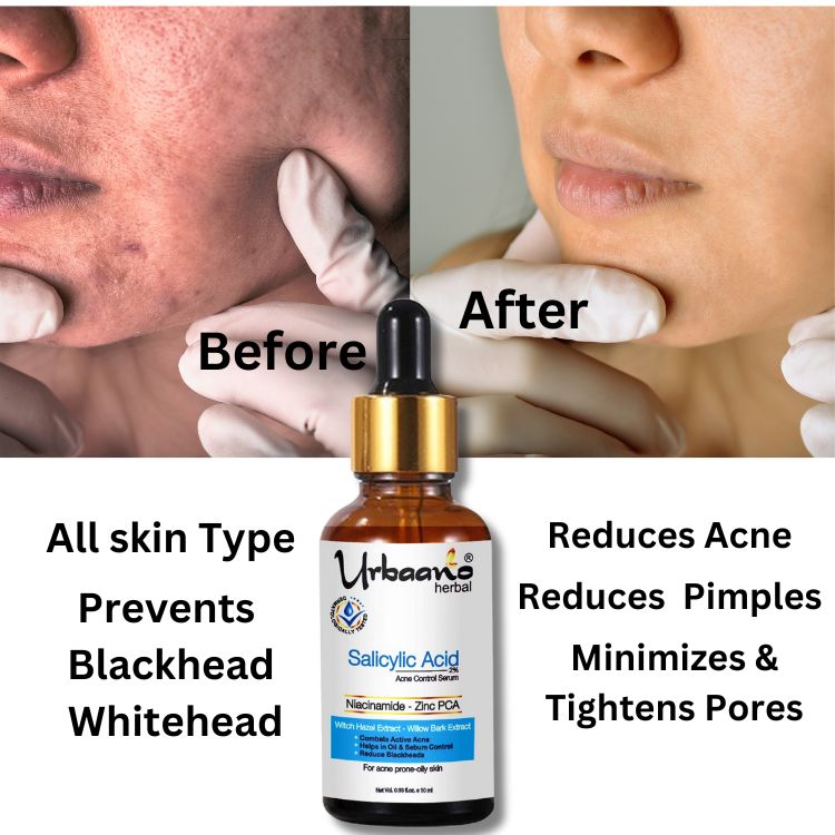 Salicylic acid 2% Face Serum, Niacinamide & Zinc PCA for Skin Brightening, Control Pimple, Acne