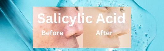urbaano herbal salicylic acid to reduce acne, excess oil